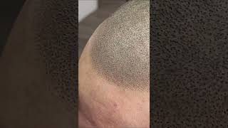 Close up of scalp Micropigmentation right after treatment shorts scalpmicropigmentation hairtatto [upl. by Ramor]