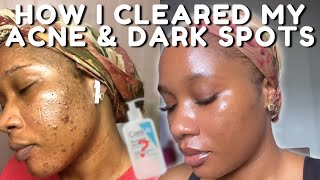 HOW I CLEARED MY ACNE BREAKOUTS AND DARK SPOTS NO TRETINOIN  iJay Amadi [upl. by Arreik]