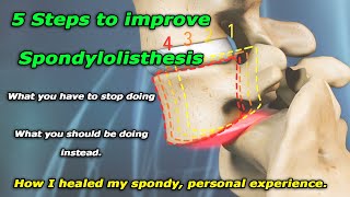 Spondylolisthesis 101 or how I healed my broken back [upl. by Shannon619]