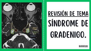 Revisión de Tema 55 Síndrome de Gradenigo [upl. by Ormond]