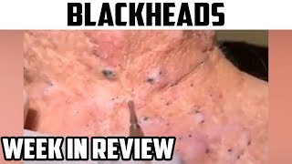 Blackhead Week in Review  Mr Blackheads Worlds Greatest Medical [upl. by Kopple]