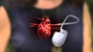 DefibrillatorPacemaker Whats the Difference [upl. by Obaza]