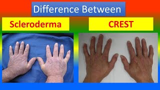 Difference between Scleroderma and CREST syndrome [upl. by Eneliak]