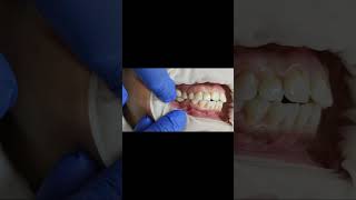 2 unit lower molar implant bridge PMMA for basal dental implants fitting video shorts [upl. by Ellenyl302]