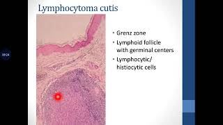 Basic Dermatopathology 13 Pattern of inflammation  Miscellaneous [upl. by Nonie]