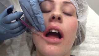 Emervel Lip Enhancement UK Treatment  Outline Clinic Droitwich Worcestershire [upl. by Attenwahs]