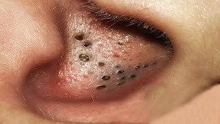 Big Cystic Acne Blackheads Extraction Blackheads amp Milia Whiteheads Removal Pimple Popping  4226 [upl. by Scherman]