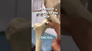 HOW DO YOU GET BONE NECROSIS OF THE HIP [upl. by Pirozzo415]