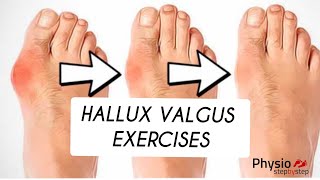 HALLUX VALGUS correction exercises IG physiostepbystep [upl. by Ahsikal487]