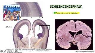 Porencephaly versus Schizencephaly 22 [upl. by Minne]