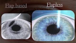 Refractive Surgery Types [upl. by Kifar]