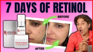 🔺RETINOL BEFORE And AFTER HALF Of HER FACE 🔺  Retinol Serum [upl. by Rahmann614]