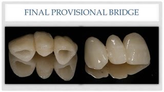 Dental Bridge The Esthetic Provisional Bridge [upl. by Mellette557]