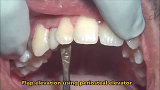 Extraction of retained milk tooth [upl. by Affay]