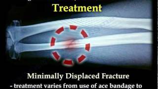 Nightstick Fracture  Ulnar Shaft fracture  Everything You Need To Know  Dr Nabil Ebraheim [upl. by Leirbaj]