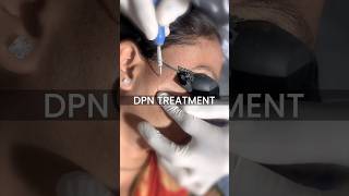 DPN treatment at Skinaa Clinic viral shorts [upl. by Lledrev]