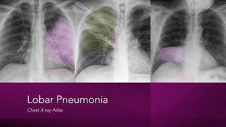 Lobar Pneumonia Chest Xray Atlas [upl. by Akenat]