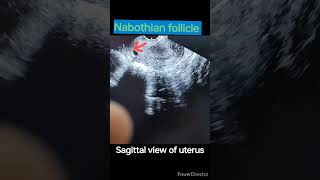 Nabothian follicle in cervix cervix cervicitisultrasound sonography doctor [upl. by Ettenahs]