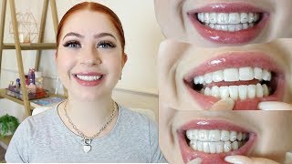 Invisalign Update  REFINEMENTS I Moriah Shae [upl. by Ivek503]