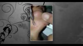 Huge Blackheads Pop on Nose  Black head [upl. by Alabaster]