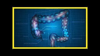 Symptome und Behandlung von Anus und Strain Cancer [upl. by Narahs]