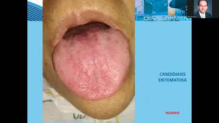 Candidiasis eritematosa [upl. by Cadel]