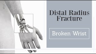 broken wrist  distal radius fractures [upl. by Dasie701]