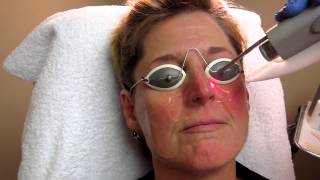 Nd YAG Laser Treatment for Rosacea at Total Body Care [upl. by Andreas629]