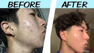 My Acne Journey Skincare Motivation [upl. by Jahdol819]