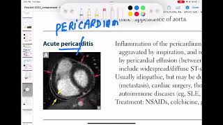 Acute Pericarditis cardiology 114 First Aid USMLE Step 1 in UrduHindi [upl. by Nostets633]