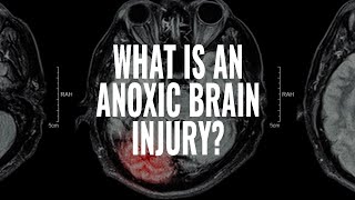 What is an Anoxic Traumatic Brain Injury I The McCraw Law Group [upl. by Yelyac341]