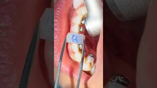 Indirect bonding of the lingual selfligating braces [upl. by Lorene254]