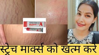 Tretinoin CreamretinoA For Strech Marks स्ट्रेच मार्क्स में ट्रेटनॉइन क्रीम का इस्तेमाल [upl. by Ecyoj]