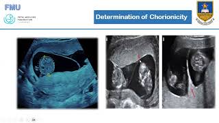 Multiple Pregnancies care and Complications Screening Dr M Ndagurwa [upl. by Gert]