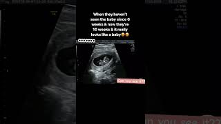 Can you see it 10 week baby movement pregnancy pregnancycare ultrasound [upl. by Francesca255]