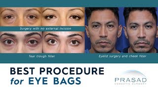 Best Procedures for Treating Puffy Under Eye Bags and Adjacent Hollowness [upl. by Gehman]