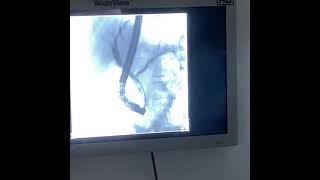 ERCP Endoscopic Retrograde Cholangiopancreatography Procedure Video [upl. by Cline100]