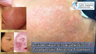 ฝ้าเลือดเกิดจากอะไร ดูแลได้อย่างไร Telangiectatic Melasma รักษาฝ้า เลเซอร์ฝ้า วิธีรักษาฝ้า [upl. by Reehsab]