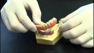 Prothese clipsee sur implant avec barre [upl. by Jessabell661]