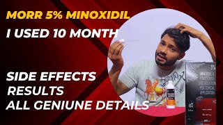 Minoxidil Morr f 5 Results  Morr F 5  Minoxidil and finasteride side effects [upl. by Ramak]