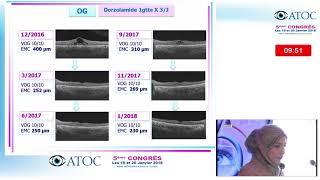 Conférence Salle 2  Session Oedemes maculaires rétine médicale Vidéo 6 [upl. by Nine]