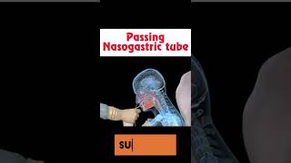 Nasogastric tube insertion 🤢🩺 shorts health [upl. by Lednek]