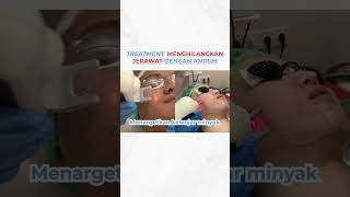 Treatment Menghilangkan Jerawat Dengan Ampuh acne jerawat acnetreatment [upl. by Dobb139]