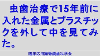 ＃顕微鏡歯科 カリエス カリエス治療 ＃虫歯治療 秋山テクニック治療15年後の検証 ＃顕微鏡歯科 ＃マイクロスコープ ＃マイクロ ＃手術用顕微鏡 [upl. by Narat]