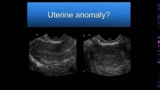 AIUM Webinar Problem Solving with 3D Sonography of the Uterus and Adnexa [upl. by Jestude]