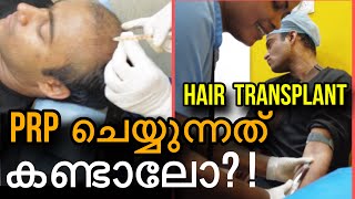 prp PRP ചെയ്യുന്നത് കണ്ടിട്ടുണ്ടോ വേദനയുണ്ടോ hairtransplant hairlossttreatment hairloss [upl. by Alywt]