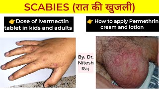 Scabies infection खाज treatment and Head lice जू treatment by Dr Nitesh Raj [upl. by Gallard]