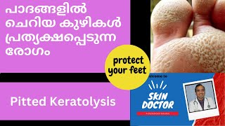 PITTED KERATOLYSIS MALAYALAM പാദങ്ങളിൽ ചെറിയ കുഴികൾ പ്രത്യക്ഷപ്പെടുന്ന രോഗം valam kadi malayalam [upl. by Juliann167]