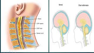 Compressive Myelopathy Lecture [upl. by Ammej]