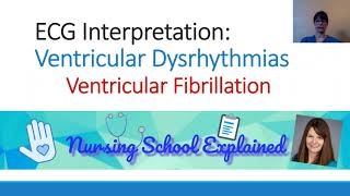 Ventricular Fibrillation VFib [upl. by Hizar114]